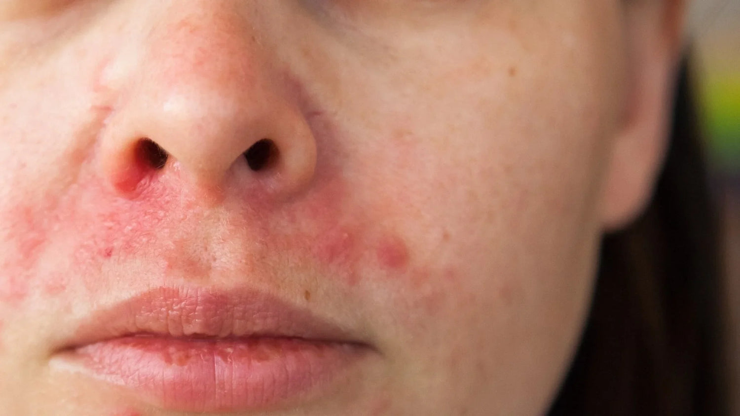 Special Products for Perioral Dermatitis